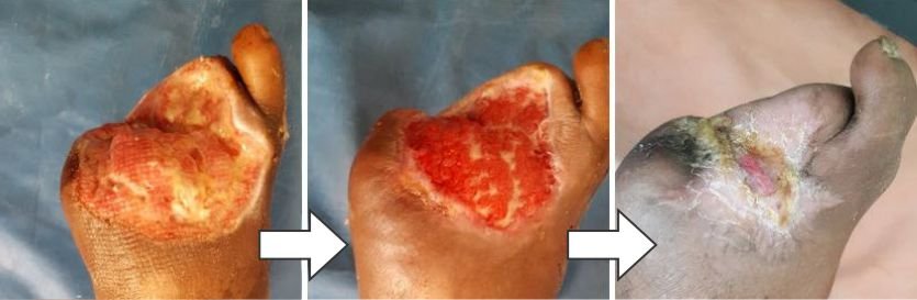 Leg Ulcers Treatment (Patient Condition Report)