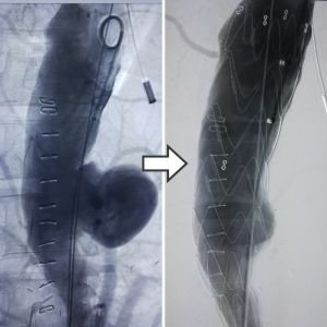 Vascular Malformation Treatment