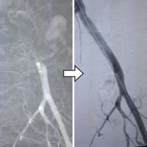 Vascular Treatments Offered