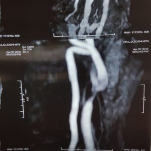 Best Treatment for Carotid Artery Stenosis Stenting Disease by Dr. Sumit Kapadia