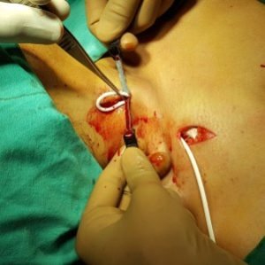 Vascular Disease in Legs