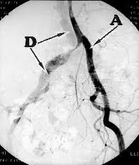Lower Limb Arterial Diseases