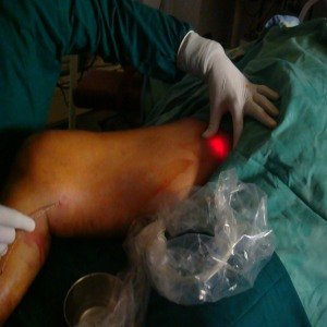 Laser For Varicose Veins