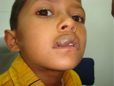 Vascular malformation lip