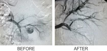 Endovascular Treatments (Before & After)