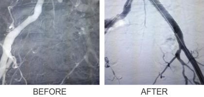 Endovascular Treatments (Before & After)