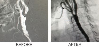 Endovascular Treatments (Before & After)