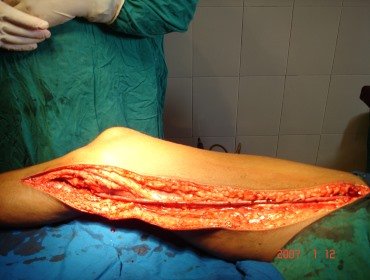 Femoro popliteal bypass using vein graft