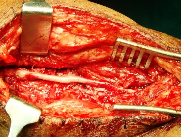 Popliteo Distal bypass