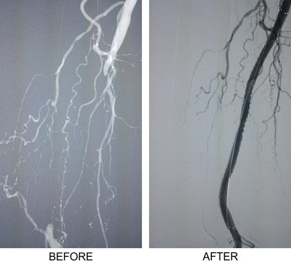 Lower Limb Arterial Diseases