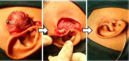 Vascular Malformations