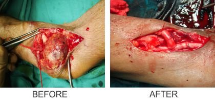 Pseudoaneurysm Repair (Before & After)
