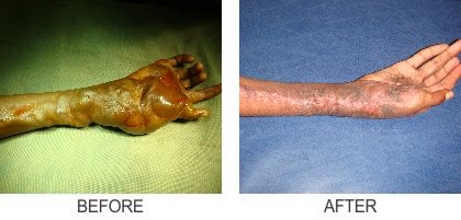 Vascular Malformation