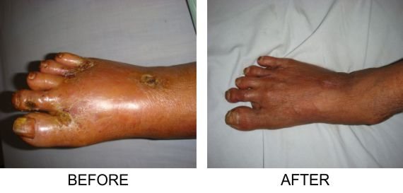 Lower Limb Arterial Diseases