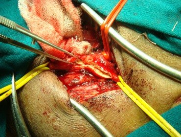 Carotid endarterectomy