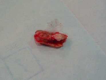 carotid plaque