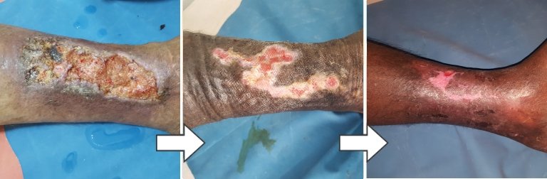 Treating Leg Ulcer