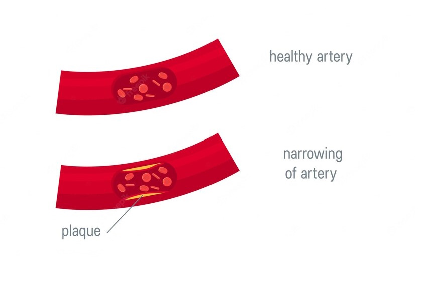 Peripheral Arterial Disease (PAD) Treatment Options