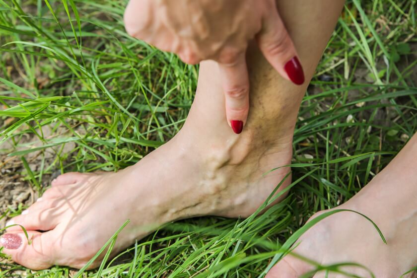 Pregnancy Varicose Veins: Varicose Veins in Pregnancy Treatment