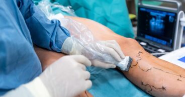 varicose veins treatment cost india