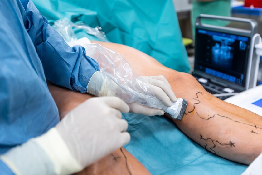 Varicose Veins Laser Treatment Cost In India | Sclerotherapy Cost