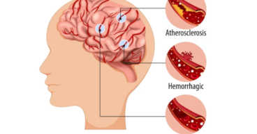 Brain Stroke - Atherosclerosis | Hemorrhagic | Ischemic