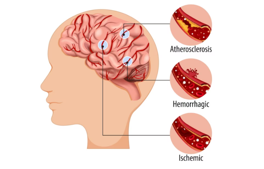 Understanding the Link Between Carotid Artery Disease and Stroke