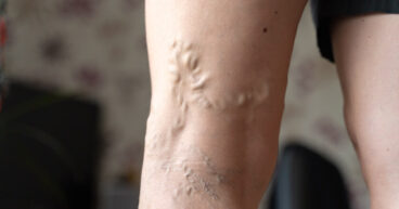 : Truth About Home Remedies for Varicose Veins: Can They Really Help?