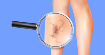 Varicose Veins Complications