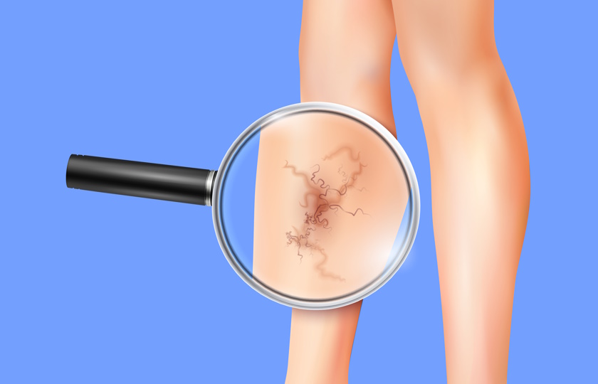 Varicose Veins Complications: How to Prevent and Manage Them