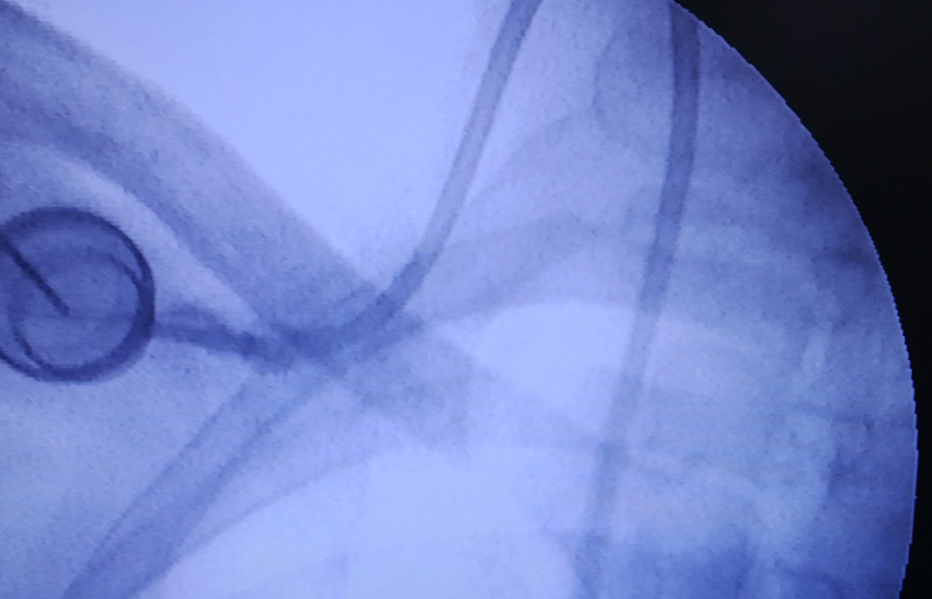 Chemoport Insertion Procedure, Cost, and Complications Explained