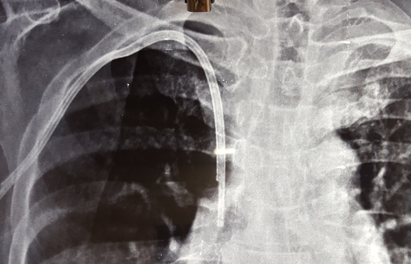 Chemoports: A Comprehensive Look at Their Operation and Significance