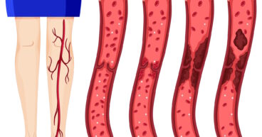 Deep Vein Thrombosis
