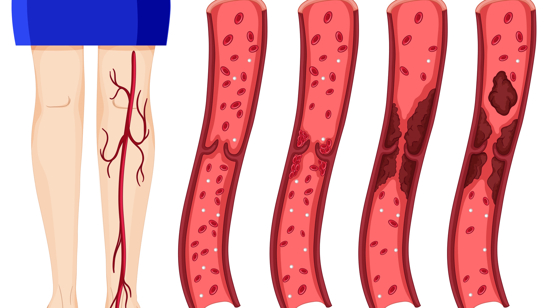 5 Early Signs & Symptoms of Deep Vein Thrombosis (DVT)