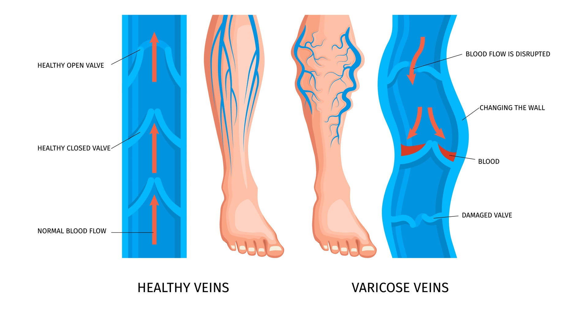 When to Worry about Varicose Veins: Identifying Complications