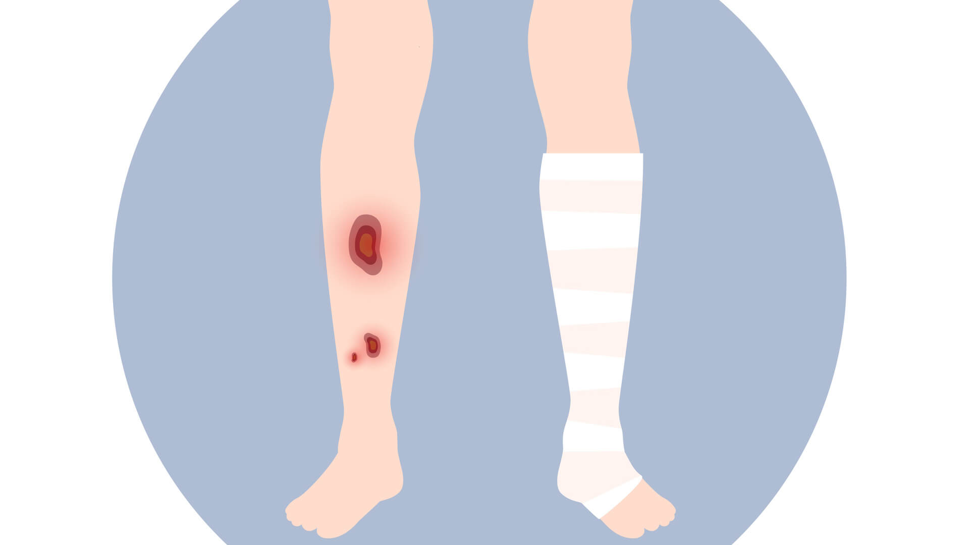 What Causes Venous Ulcers and How to Prevent Them