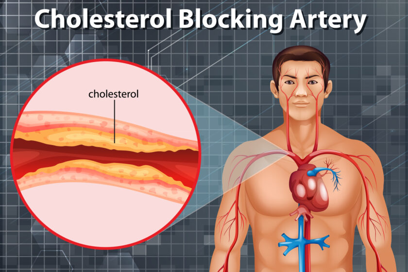 Angiography Explained: Types, Procedure, Cost and Uses