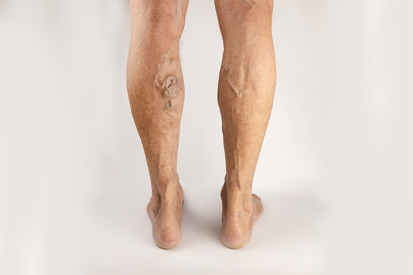 Vascular Malformation Treatment: A Comprehensive Guide