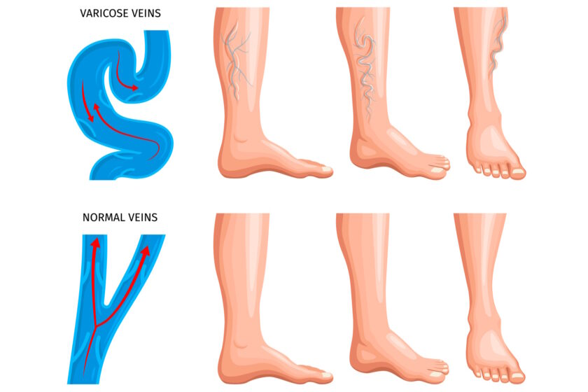 Varicose Veins: 7 Signs You Should See a Doctor