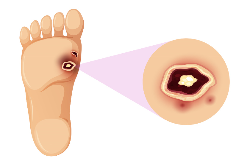 Everything You Need to Know About Diabetic Ulcers