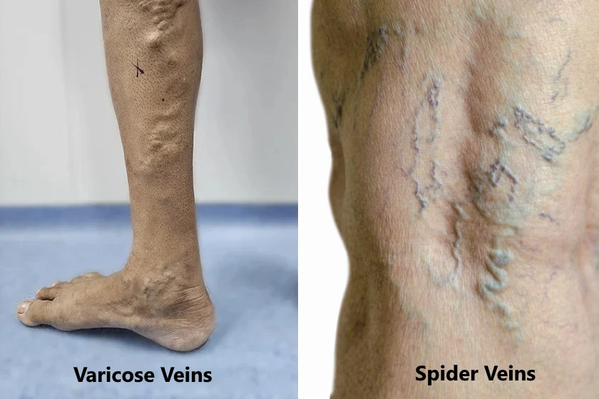 What is the Difference Between Spider Veins and Varicose Veins? The Ultimate Guide