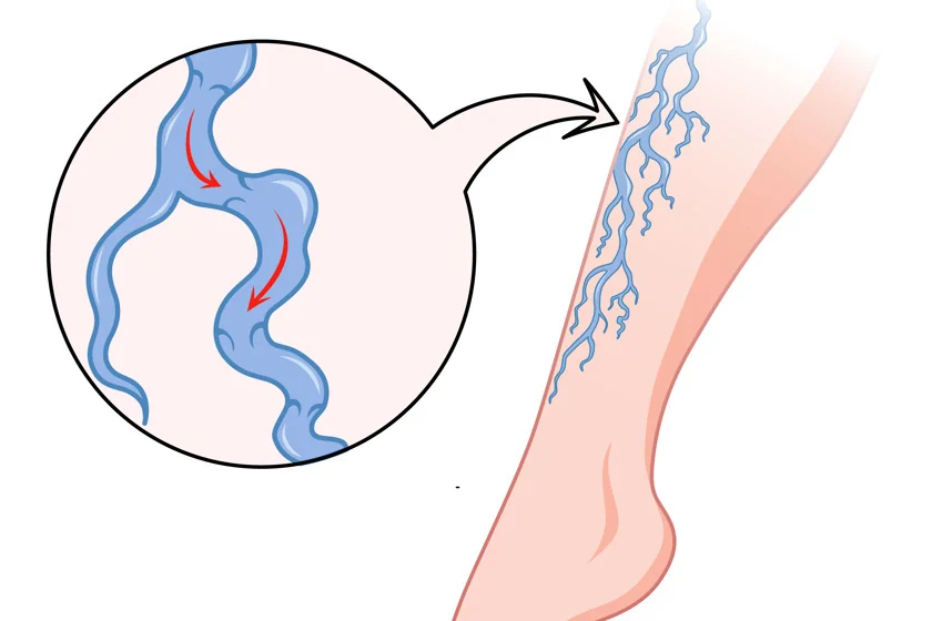 The Optimal Timing for Treating Varicose Veins: Do Cooler Months Matter?
