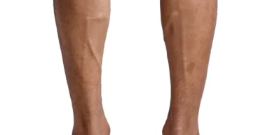 Impact of Exercise on Varicose Veins-Best Workouts for Circulation and Prevention