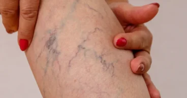 Why Are My Veins So Visible All of a Sudden?