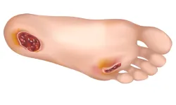 Diabetic foot