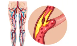 Peripheral Arterial Disease-01