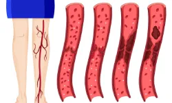 Vein Thrombosis-01
